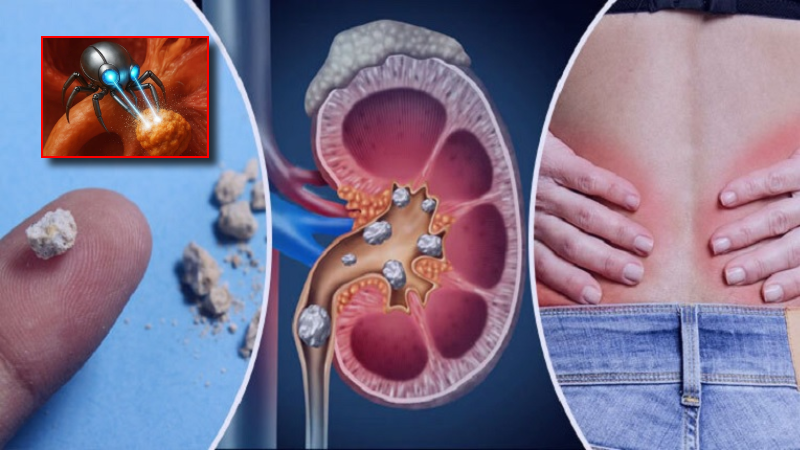 অস্ত্রোপাচার ছাড়াই কিডনির পাথর দূর করবে রোবট